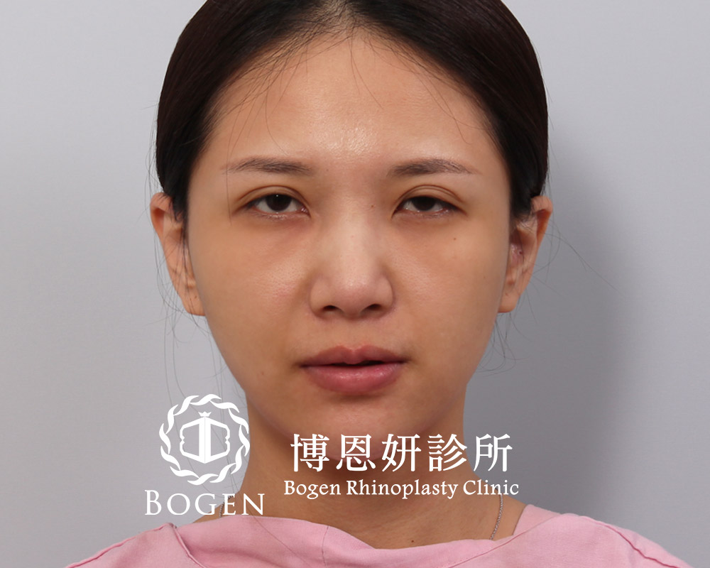 眼褶不對稱搭配提眼瞼肌無力,博恩妍
